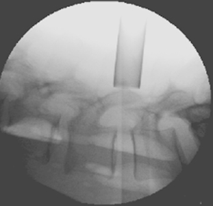 Minimally Invasive Microdiskectomy X-Ray