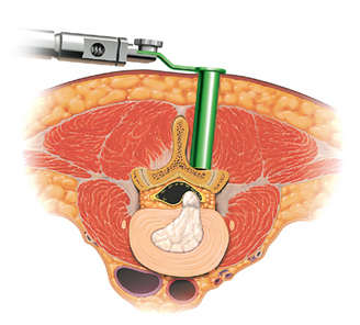 Minimally Invasive Microdiskectomy Illustration